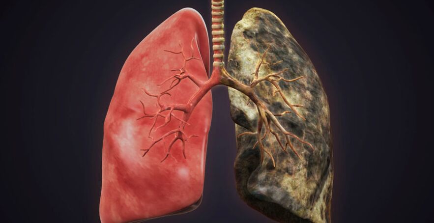 pulmão de fumante e parar de fumar pulmão